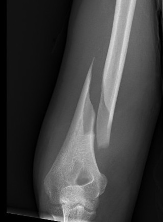 Holstein Lewis fracture